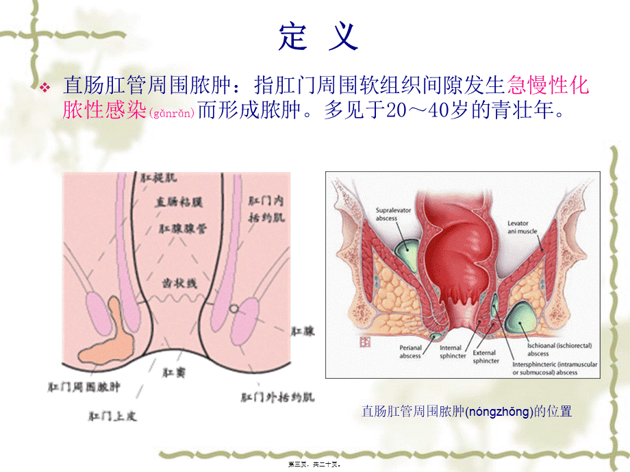 2022年医学专题—肛周脓肿ppt.ppt_第3页