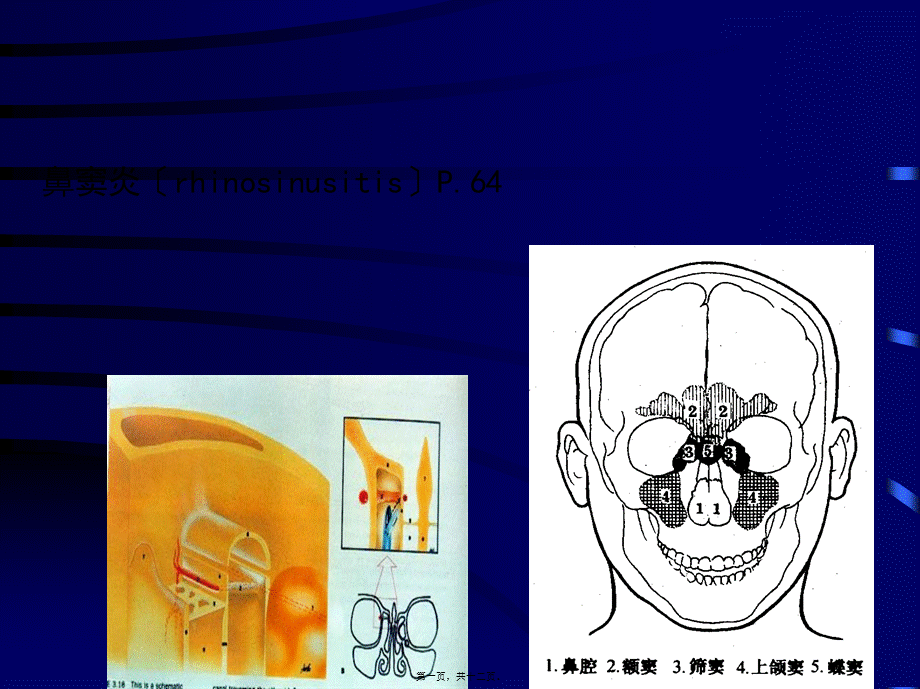 2022年医学专题—鼻窦炎(1).ppt_第1页