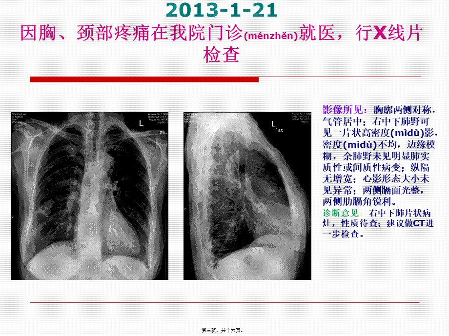 2022年医学专题—空洞型肺结核--病例讨论(1).ppt_第3页