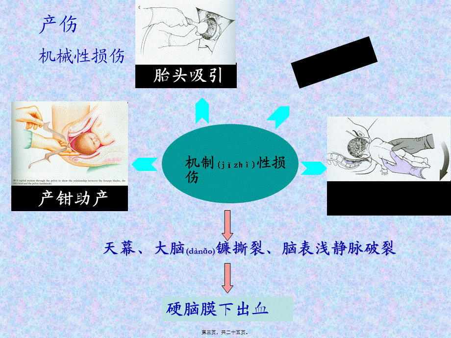 2022年医学专题—章节新生儿颅内出血.ppt_第3页