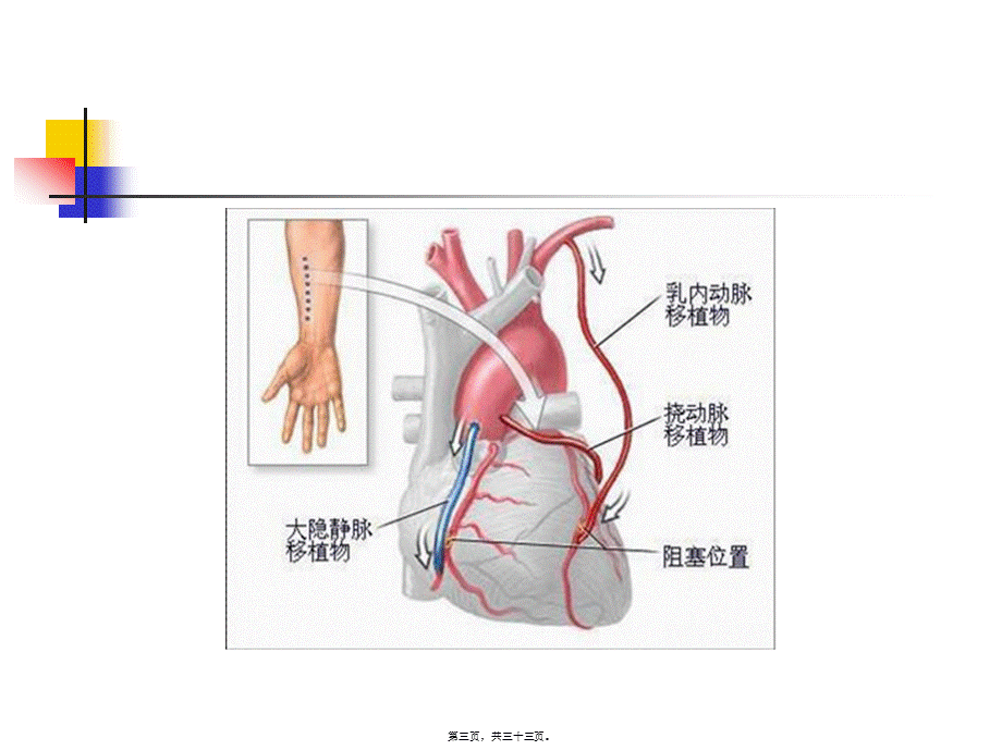 2022年医学专题—冠脉搭桥术健康宣教.ppt_第3页