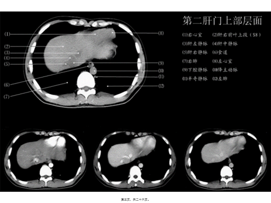 2022年医学专题—上腹部CT-各个层面.ppt_第3页