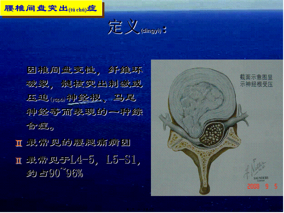 2022年医学专题—椎间盘突出症(1).ppt_第2页