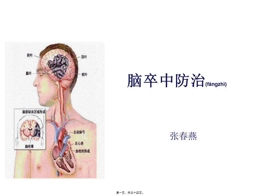 2022年医学专题—脑卒中防治.ppt_第1页