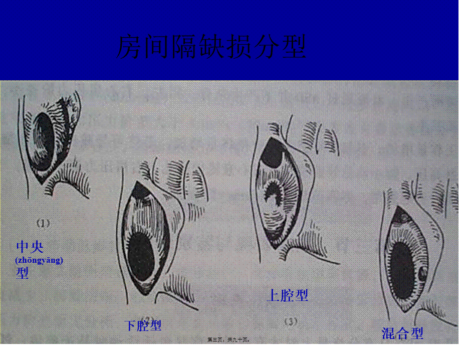 2022年医学专题—先心病封堵器研制现状概要(1).ppt_第3页