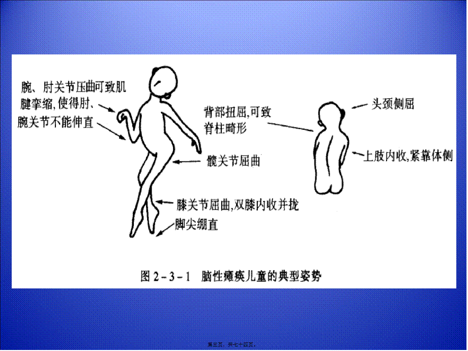 2022年医学专题—小儿脑瘫康复.ppt_第3页