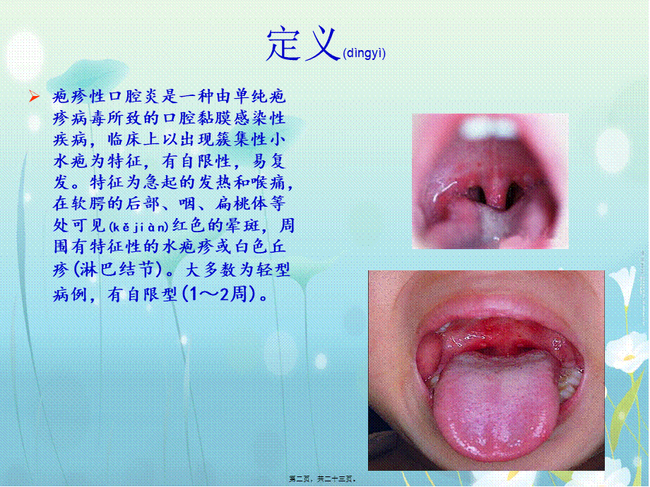 2022年医学专题—疱疹性咽峡炎.ppt2.ppt_第2页