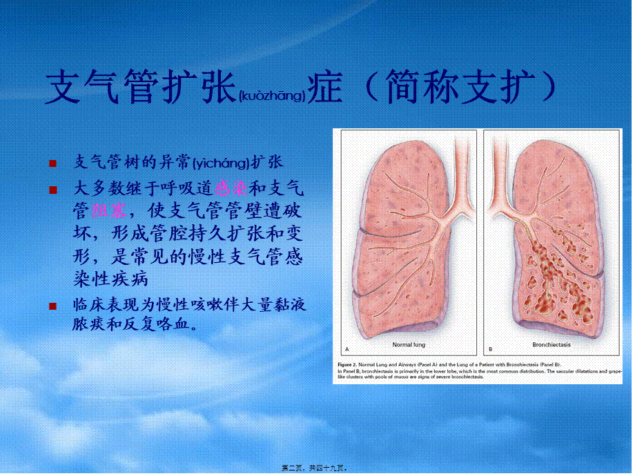 2022年医学专题—支气管扩张bronchiectasis(1).ppt_第2页