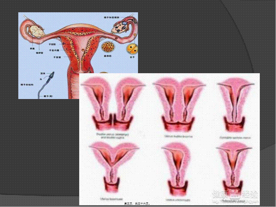 子宫畸形及三维成像.pptx_第3页