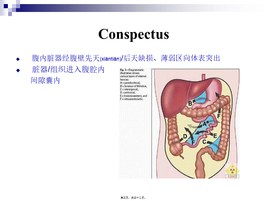 2022年医学专题—腹外疝(上网版).ppt_第3页