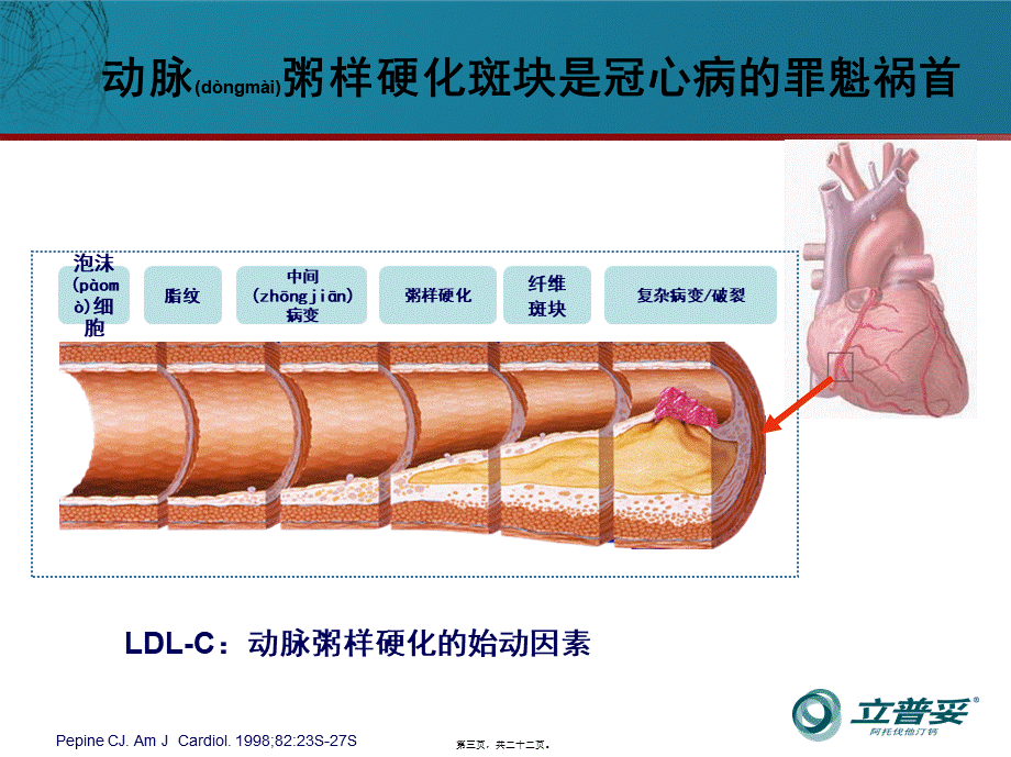 2022年医学专题—稳定性冠心病不稳定PIM(1).ppt_第3页