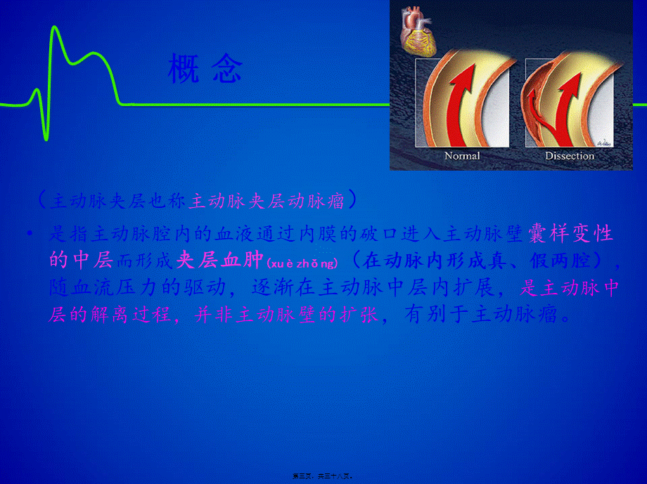 2022年医学专题—主动脉夹层(修改版)(1).ppt_第3页