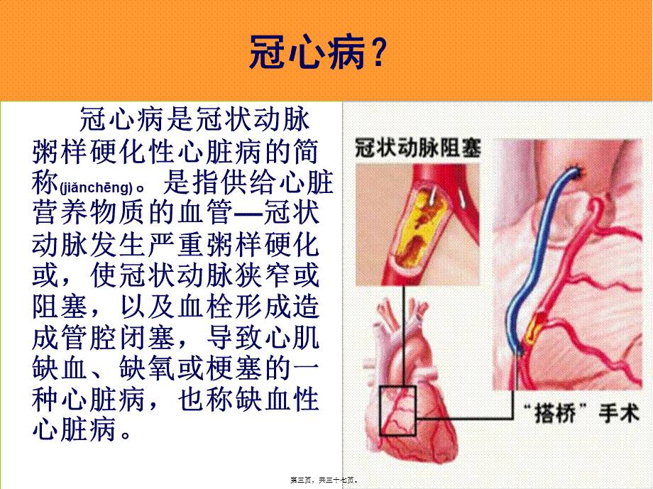 2022年医学专题—心脏搭桥的健康指导.ppt_第3页