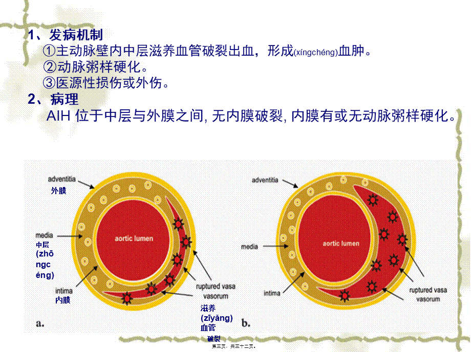 2022年医学专题—壁内血肿演变及CT表现(讲课).ppt_第3页