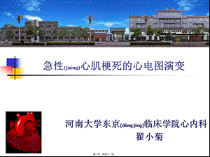 2022年医学专题—急性心肌梗死的心电图演变.ppt