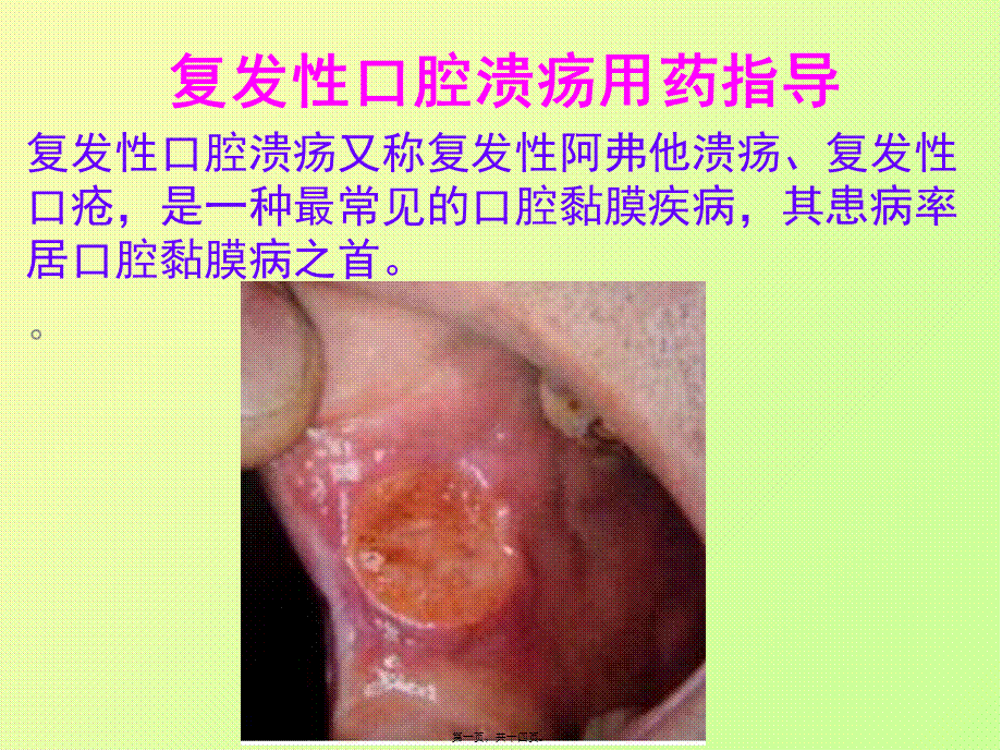 复发性口腔溃疡用药指导.pptx_第1页