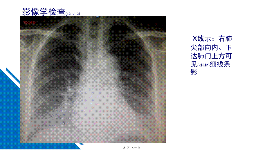 2022年医学专题—肺奇叶.pptx_第2页