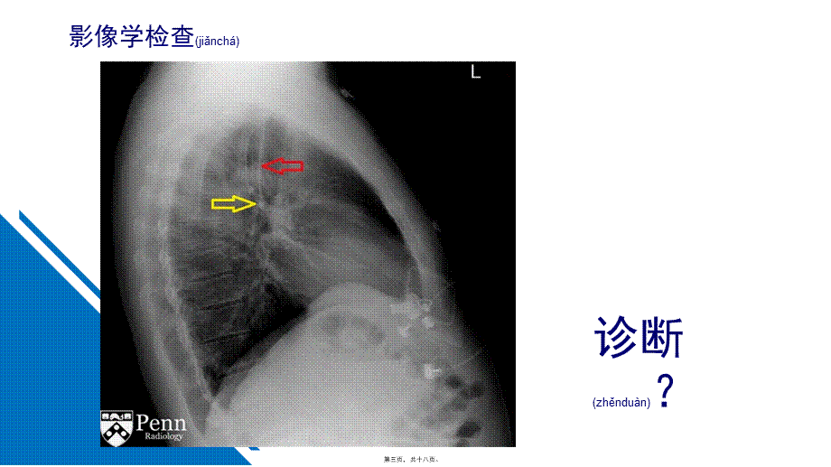 2022年医学专题—肺奇叶.pptx_第3页