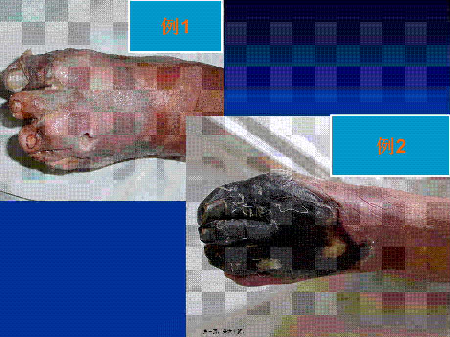 2022年医学专题—《糖尿病足》-PPT文档.ppt_第3页