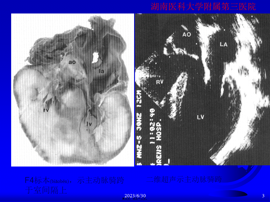 2022年医学专题—心脏超声检查刘明辉湘雅.ppt_第3页
