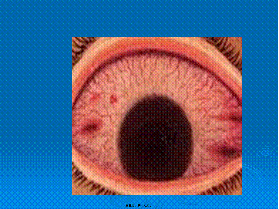 2022年医学专题—急性出血性结膜炎.ppt_第3页