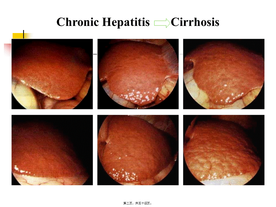 2022年医学专题—第四篇-第十四章-肝硬化分解.ppt_第2页