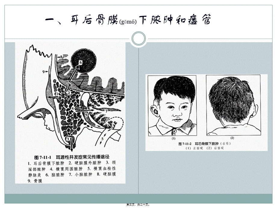 2022年医学专题—中耳炎颅外并发症.pptx_第3页