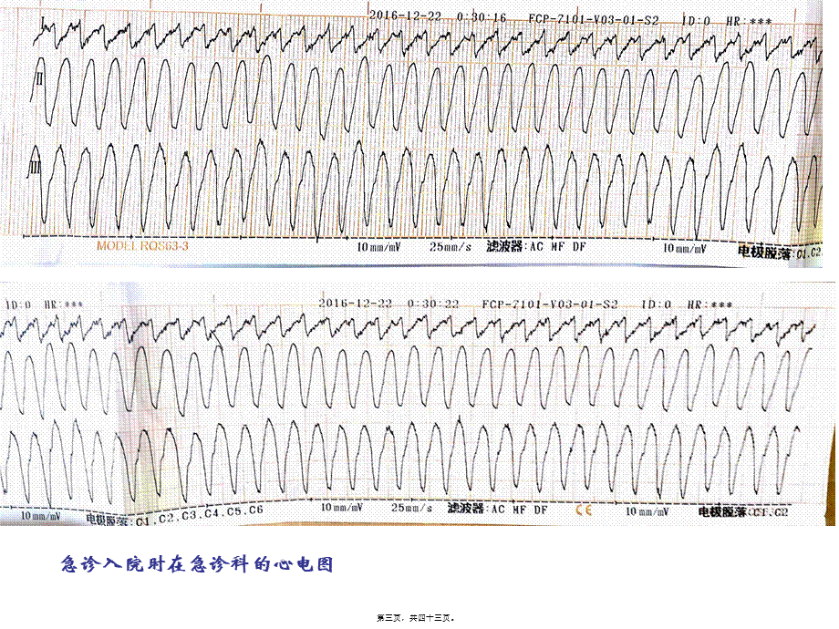 室速风暴病例分享.pptx_第3页