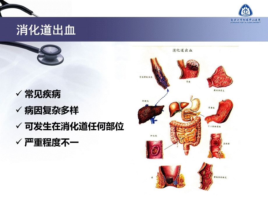 不明原因消化道出血的诊疗进展.ppt_第2页