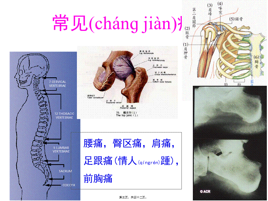 2022年医学专题—AS髋关节受累的思考.ppt_第3页