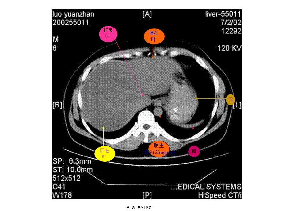 2022年医学专题—腹部CT读片.ppt_第3页