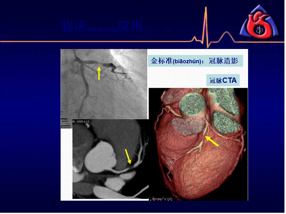 2022年医学专题—冠脉CTA读片(非常经典).ppt_第2页