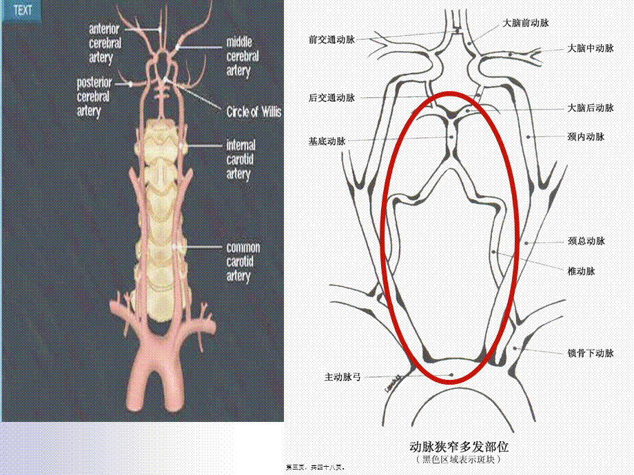 后循环缺血专家共识.pptx_第3页