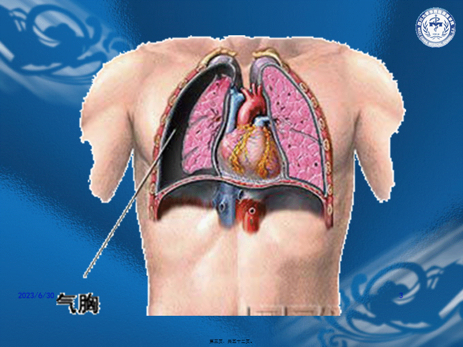 2022年医学专题—气胸的诊治.ppt_第3页
