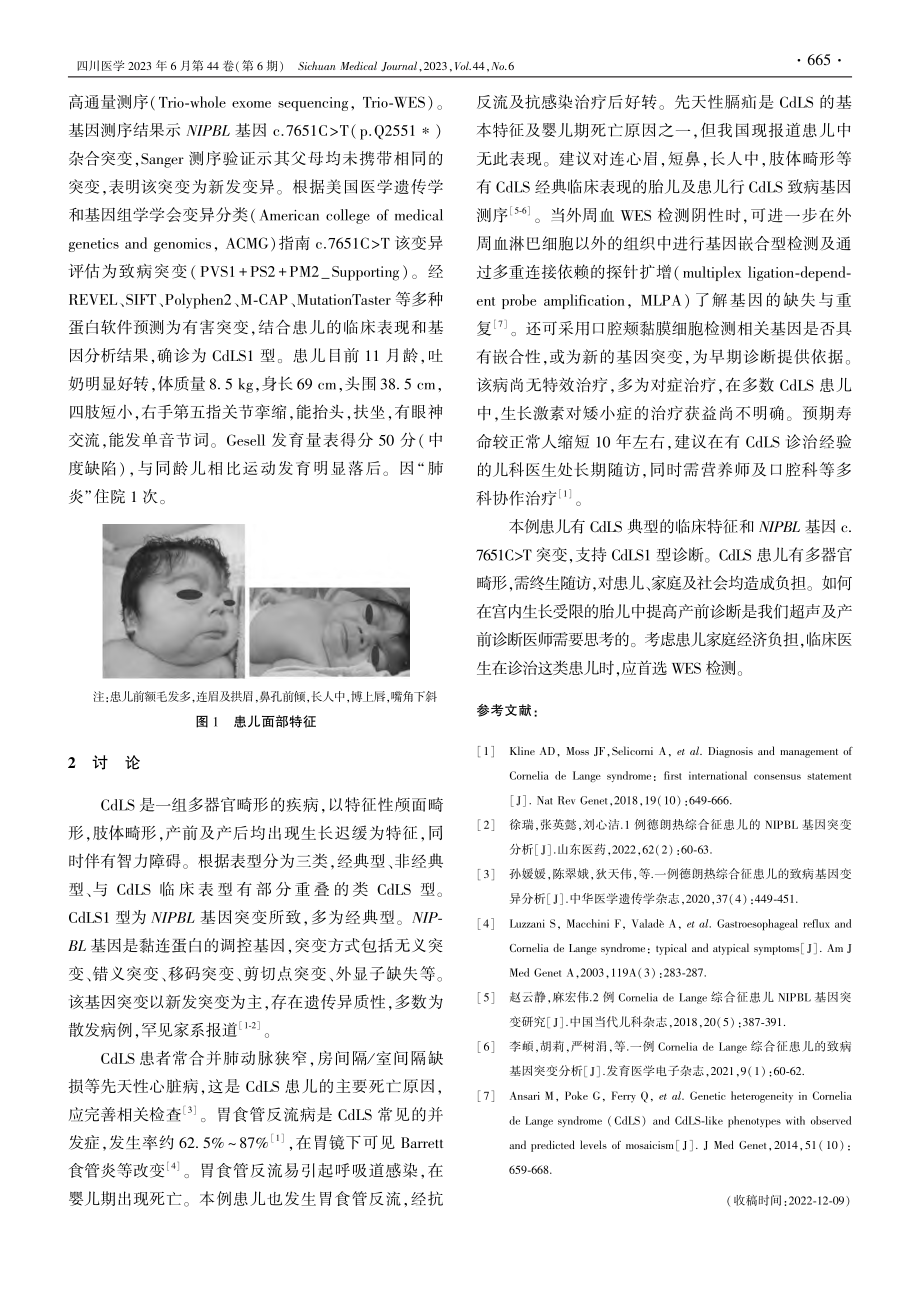 NIPBL基因新生突变致德朗热综合征1例_张衡.pdf_第2页