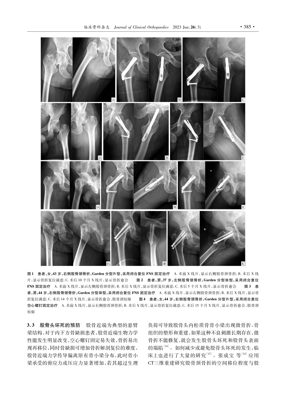 两种固定方法治疗股骨颈骨折的疗效比较_张红新.pdf_第3页