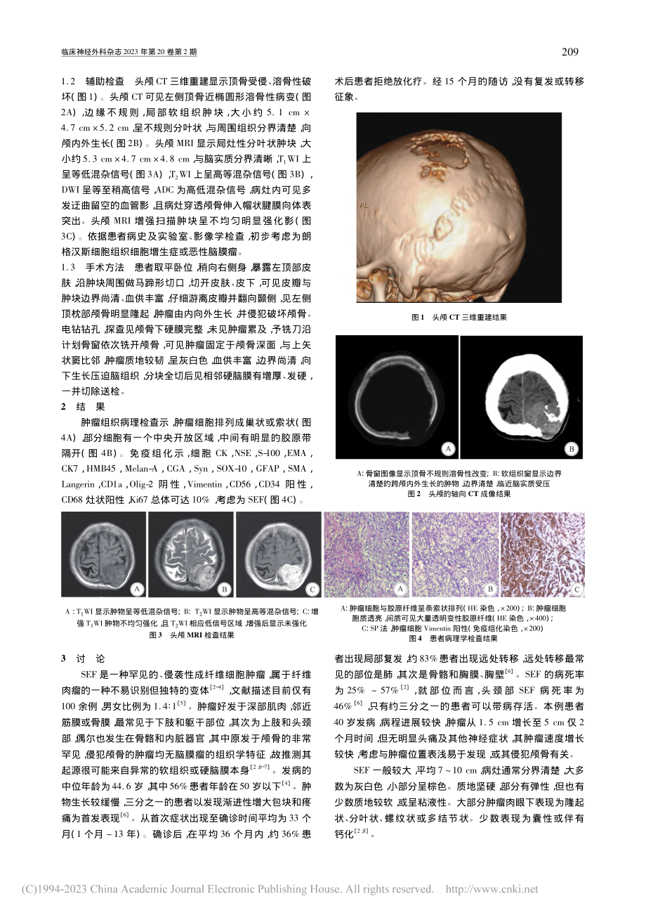 颅骨硬化性上皮样纤维肉瘤1例报告并文献复习_赵春瑞.pdf_第2页