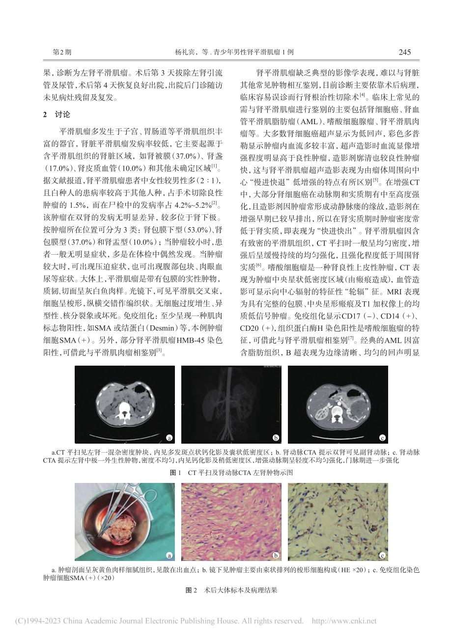 青少年男性肾平滑肌瘤1例_杨礼宾.pdf_第2页