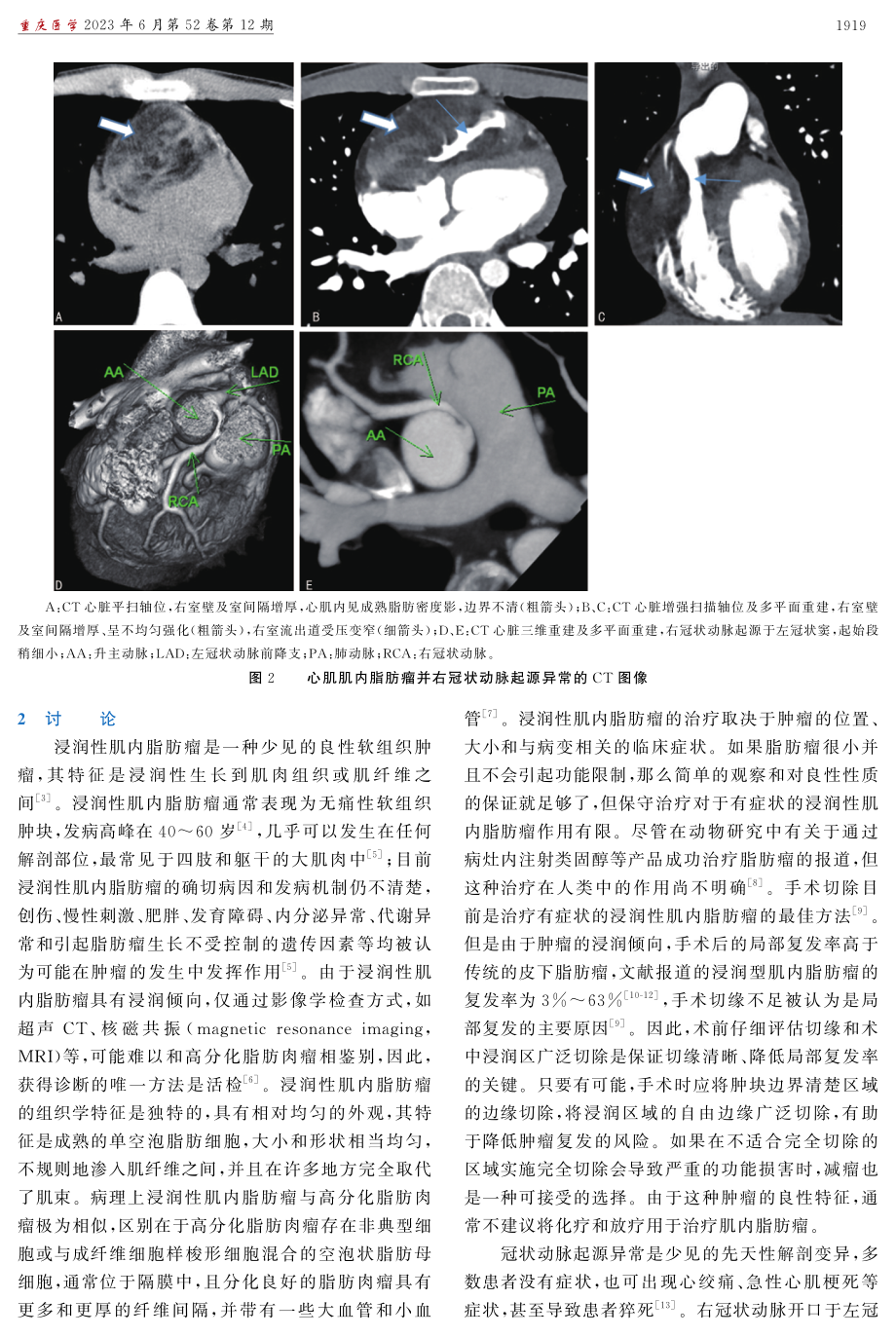 1例心肌浸润性肌内脂肪瘤合并右冠状动脉起源异常报道.pdf_第2页