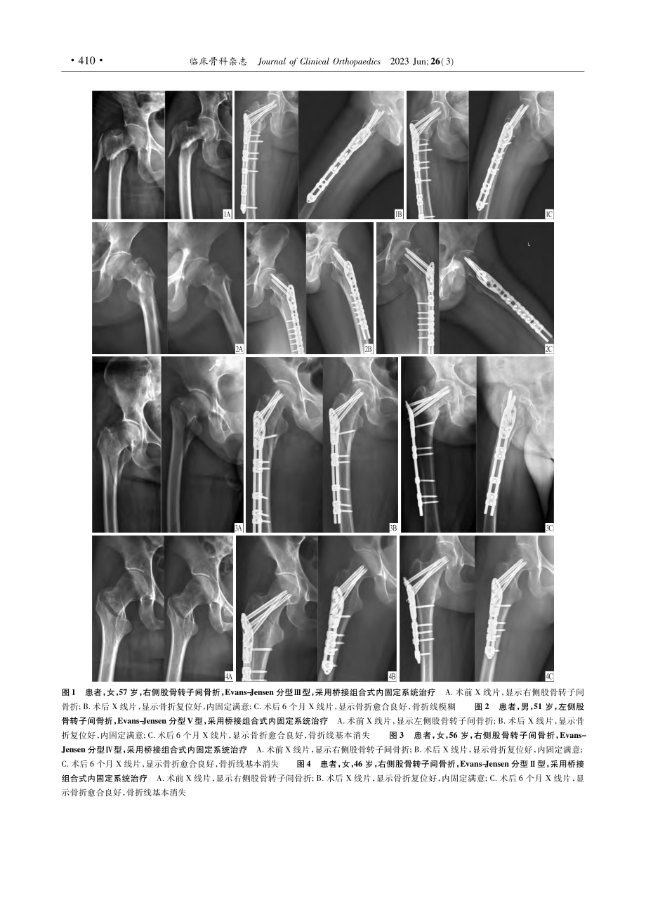 桥接组合式内固定系统治疗股骨转子间骨折_戴厚杰.pdf_第3页