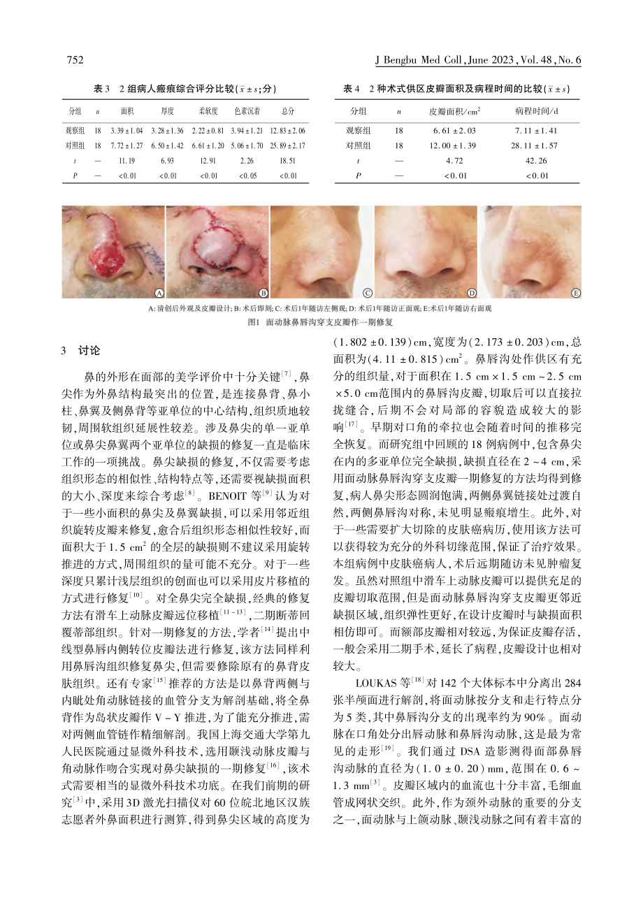 面动脉鼻唇沟穿支皮瓣一期修复鼻尖缺损的临床观察_蒋邦红.pdf_第3页