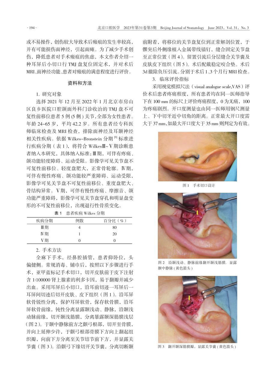 耳屏后切口颞下颌关节盘复位固定术手术入路及效果评价_刘国林.pdf_第2页