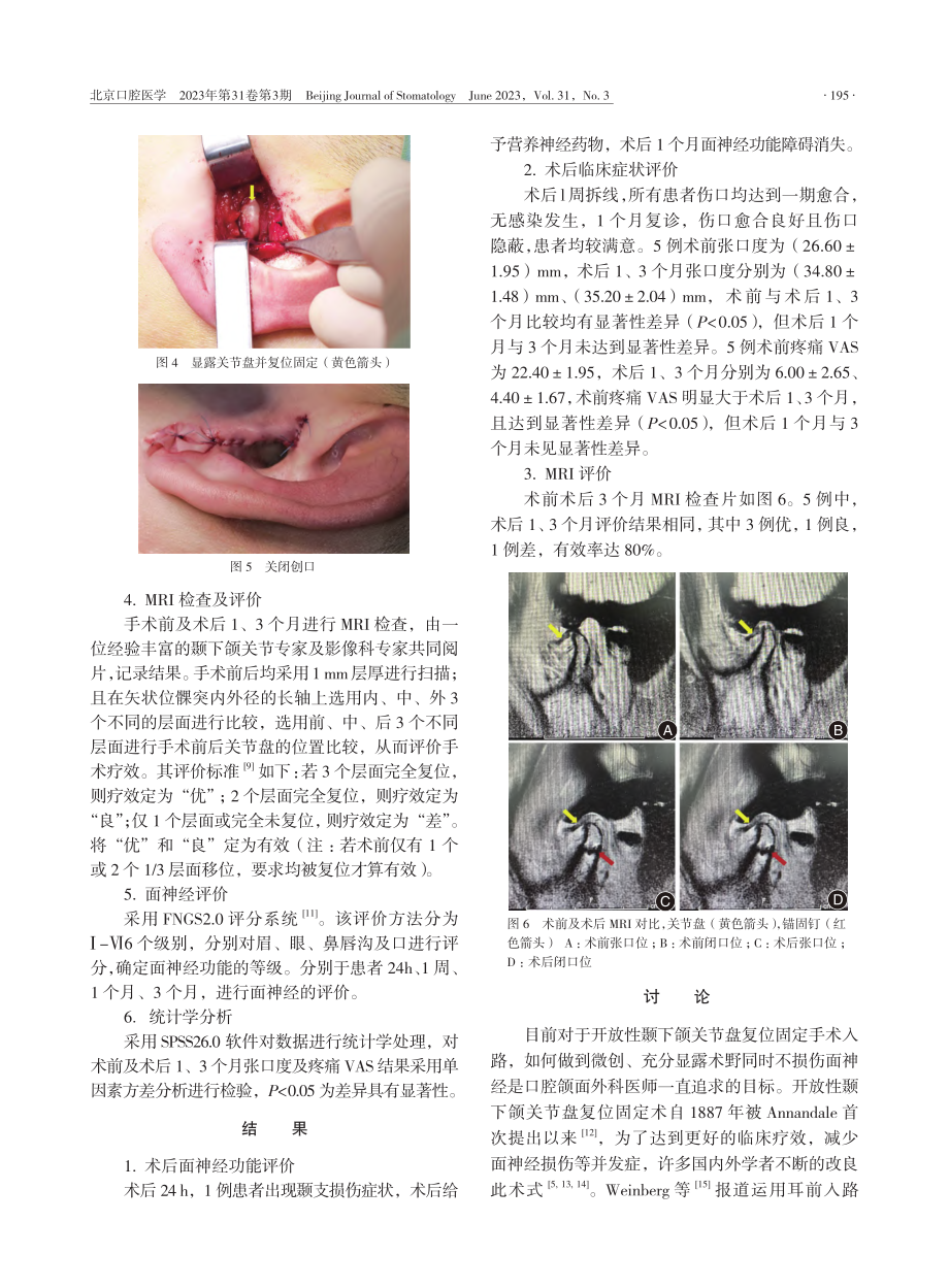 耳屏后切口颞下颌关节盘复位固定术手术入路及效果评价_刘国林.pdf_第3页