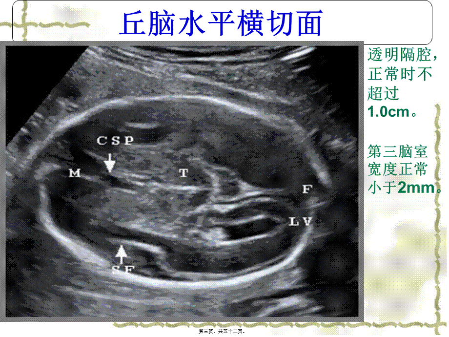 中孕期胎儿超声检查标准切面.pptx_第3页