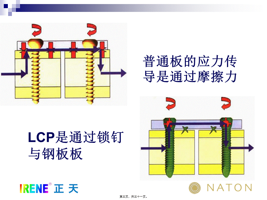 LCP系统接骨板的注意问题及常见问题(免金币).pptx_第3页