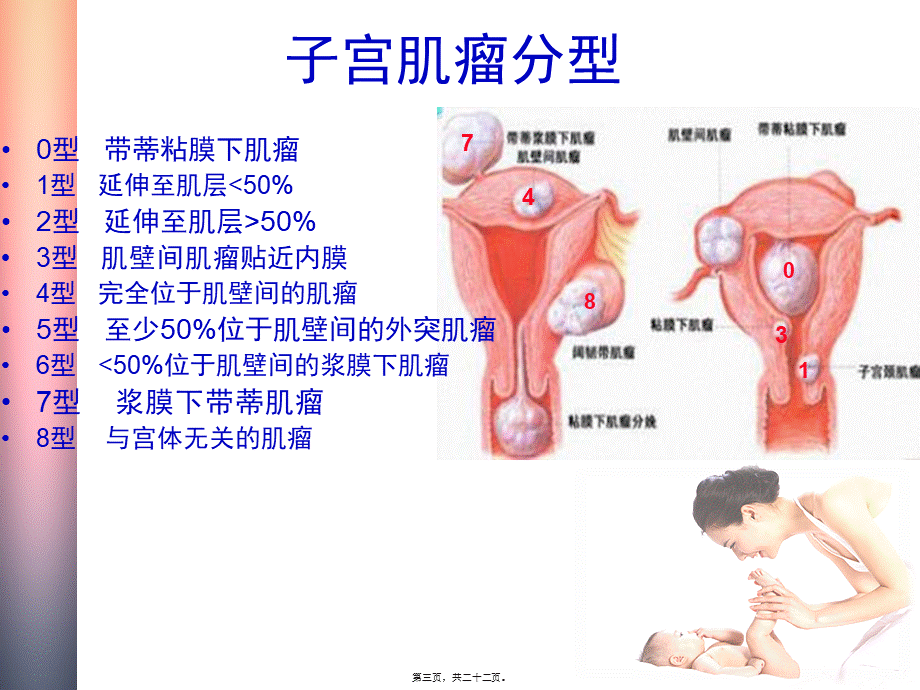 不孕妇女子宫肌瘤的处理策略.pptx_第3页