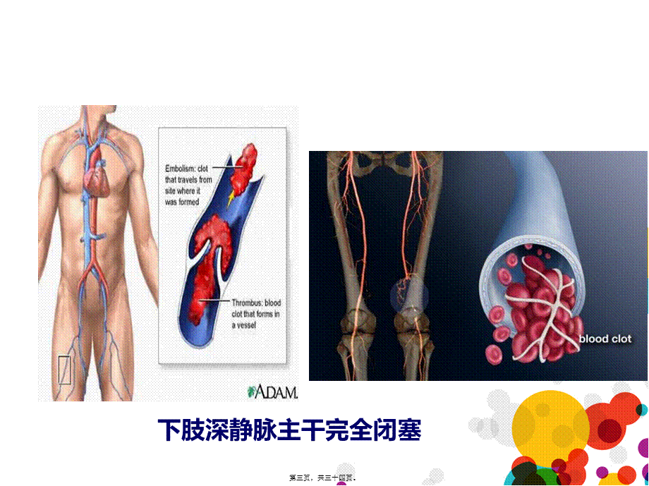 下肢深静脉血栓诊疗.pptx_第3页