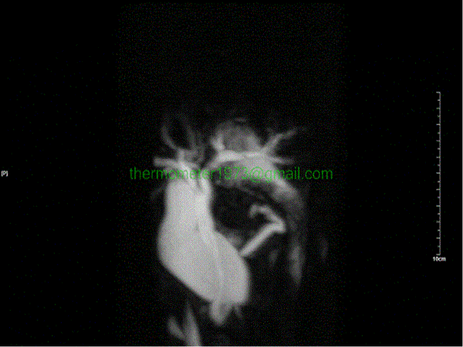 PTCD介入手术.pptx_第3页