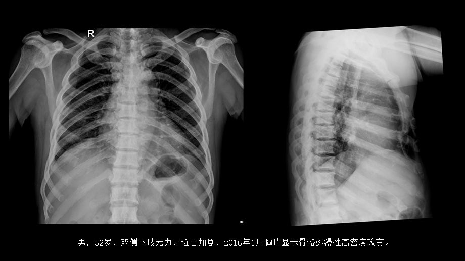 氟骨症的X线CT及MR影像及解读(1).pptx_第2页