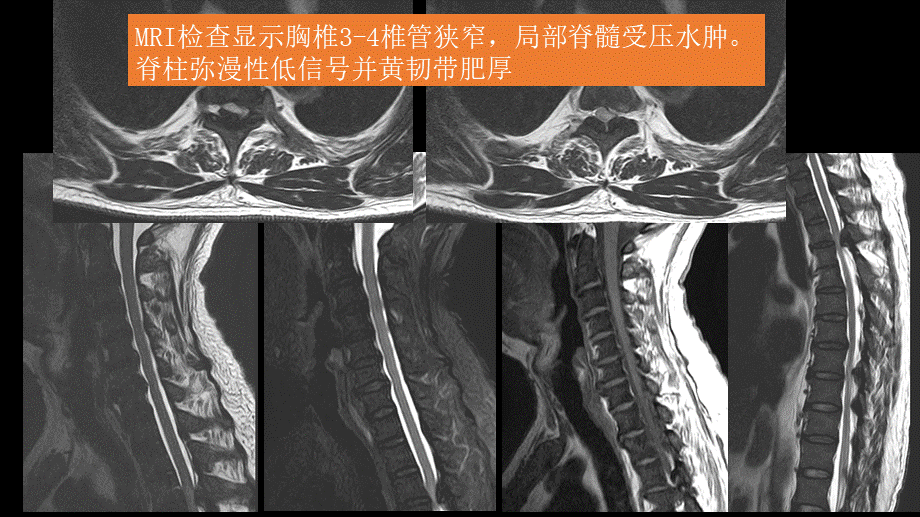 氟骨症的X线CT及MR影像及解读(1).pptx_第3页